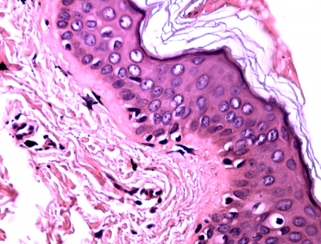 Гистология через 3 дня после процедуры HELEO4
